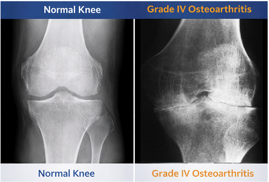 knee osteoarthritis x-ray showing joint space narrowing