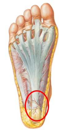 pain area of plantar fasciitis
